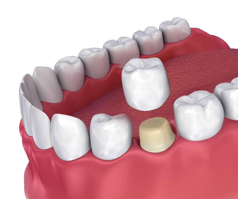 dental-crowns